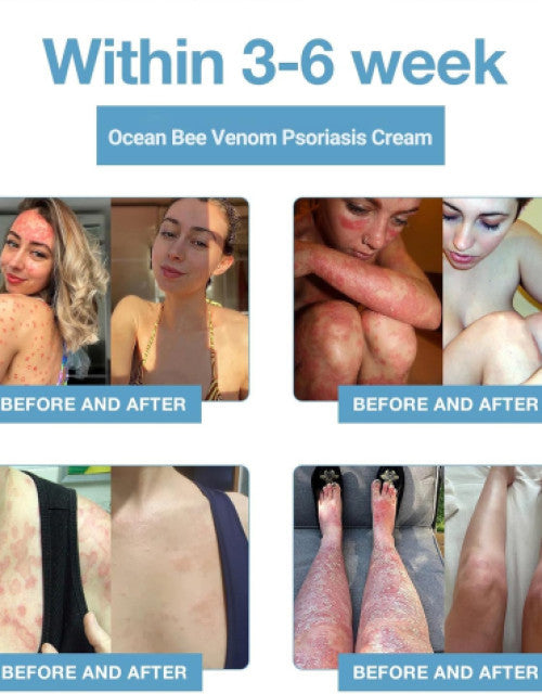 Bee Venom & Ocean Psoriasis Healing Cream ( Pack Of 1 )